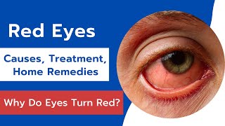 Red Eyes Causes Treatment and Home Remedies  Effective Home Remedies For Red Eyes [upl. by Asilrahc43]