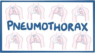 Pneumothorax  causes symptoms diagnosis treatment pathology [upl. by Oberstone434]