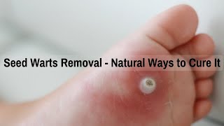 Seed Warts Removal  Natural Ways to Cure It [upl. by Lisk]