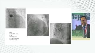 Primary PCI Our experience by Dr Md Arifur Rahman [upl. by Crissie]