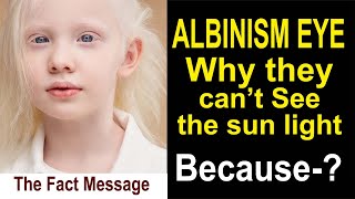 ALBINISM EYE  The hidden Fact [upl. by Ysdnyl]