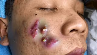 Big Cystic Acne Blackheads Extraction Blackheads amp Milia Whiteheads Removal Pimple Popping [upl. by Rabelais535]