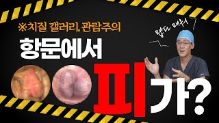 항문출혈 혈변의 원인은 사진으로 보는 항문질환 치질 치핵 [upl. by Fesuoy]