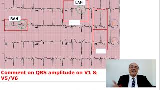 EKG Trainer Case 5 Answer [upl. by Anigriv]