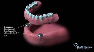 Overdenture Chairside Technique [upl. by Aldric]