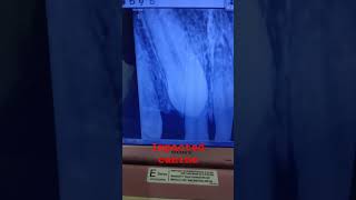 Impacted canineviralshort wisdomtoothmemes dentaltreatmentdentist popularshortsrobingargmodi [upl. by Eilahs]