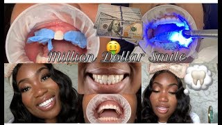 My million dollar smile transformation experience  Composite Resin Veneers [upl. by Nnylrats]