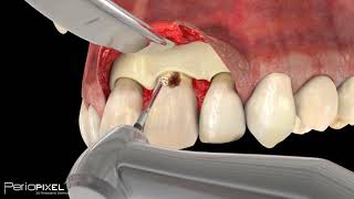 Avance vídeo completo quotCaries Subgingivalquot  PerioPixel [upl. by Bushweller755]