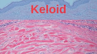 What is a Keloid  Pathology mini tutorial [upl. by Nreval]