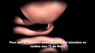 Bypass gastrico laparoscopico 2wmv [upl. by Jojo473]