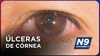 ÚLCERAS DE CÓRNEA  NOTICIERO 9 [upl. by Murry]