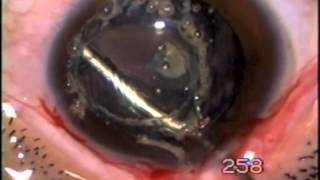 Capsulotomy with Fugo blade in Posterior polar cataract [upl. by Ardnasac465]