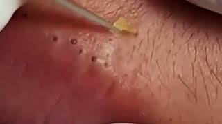 The Most Painful Blackhead Removal Video on Lips 2024 [upl. by Deutsch]