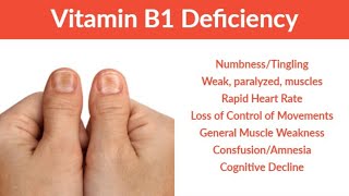 Thiamine Vit B1 Thiamine Vit B1Deficiency  Signs  Symptoms amp Treatment [upl. by Fitzsimmons]