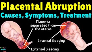 Placental Abruption Causes Symptoms Diagnosis Treatment Complications amp Prevention [upl. by Burkhardt]