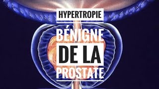 Hypertrophie Bénigne de la Prostate  partie 01 Introduction Anatomopathologie [upl. by Anomor693]