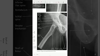 Hip Xray ☢️xraytechnician xray xraytechtrending virahipxray [upl. by Airemaj]