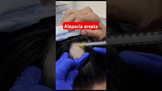 Alopecia areataintralesional corticosteroid injection dermatology mbbs medicalinternshipvmmc [upl. by Ardeth517]