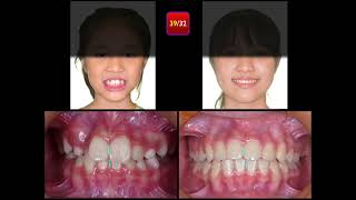 Molar Ankylosis｜【Chris Chang Ortho】CC796 [upl. by Aydni548]