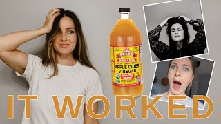 30 DAY CHALLENGE  Apple Cider Vinegar Hair Rinse  SHOCKED [upl. by Zeni111]