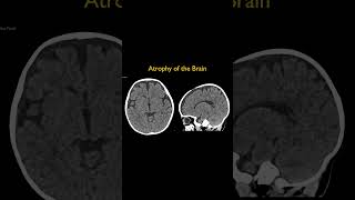 Atrophy of the Brain [upl. by Gilemette388]