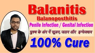 Balanitis  How to Cure Balanitis  पुरुष के अंग में सूजन जलन और इन्फेक्शन का इलाज [upl. by Stauffer]