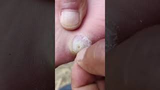 Callus removal and Dead skin removal from Feet ep76  Yin Clinic [upl. by Minardi]