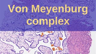 What are Von Meyenburg Complexes  Pathology mini tutorials [upl. by Margaux108]