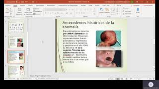 Sindrome de Edwards o Trisomia 18 [upl. by Mclaughlin]