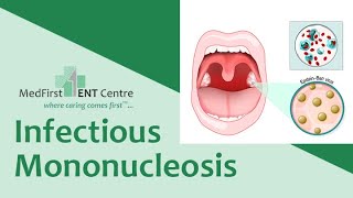 Infectious Mononucleosis Explained  Symptoms Causes amp Treatment  GlandularFever tonsilitis [upl. by Enelear]