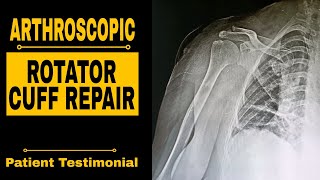 ARTHROSCOPIC ROTATOR CUFF REPAIR [upl. by Aikyt354]