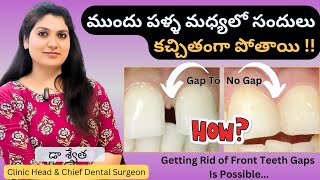 3 Best Teeth Gap Treatment  Diastema  Gap Teeth Filling  Palla Sandulu in Telugu  Dr Swetha [upl. by Aihsinyt]