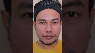 AMAZING RESULT by COSMELAN PACK NEW skincareroutine feelgood friday mensfriday mesoestetic [upl. by Tyson]