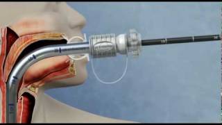 Food bolus retrieval using the GUARDUS™ Overtube and TALON™ Grasping Device [upl. by Mackenie]