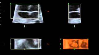 Válvulas tricuspide y mitral en un feto de 29 semanas [upl. by Ranjiv]