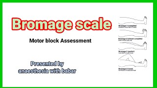 Bromage scale  motor block Assessment anaesthesiawithbabar2576 short [upl. by Nitreb]