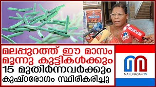 മൂന്നു കുട്ടികള്‍ക്കും15 മുതിര്‍ന്നവര്‍ക്കും കുഷ്ഠരോഗം സ്ഥിരീകരിച്ചു I Leprosy [upl. by Reine851]