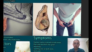 Testicular Cancer Symptoms causes and treatment [upl. by Aube]