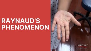 Raynauds Syndrome Phenomenon HELPED by Dr Suh Gonstead Chiropractic NYC [upl. by Llewon154]