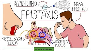 Epistaxis  Nose bleeding NGMedicals [upl. by Ednutey]