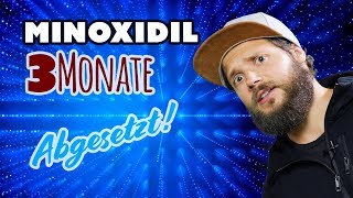 MINOXIDIL 3 Monate abgesetzt  Gipsfuß Update  Das Minoxidil Experiment [upl. by Kermie]