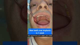 New Teeth Placed over Basal Implants in 7 days Dr Srishti Bhatia smilemakeover [upl. by Ariom]