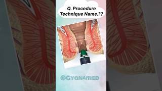 Procedure technique name [upl. by Budde]