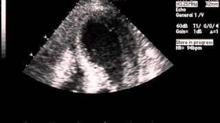 Transthoracic Echocardiogram Showing Akinesis on Apical FourChamber View [upl. by Saito]