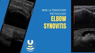 Posterior elbow synovitis short axis [upl. by Lynea]