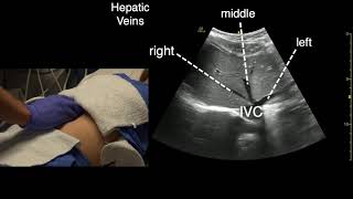 Transverse Liver Scan Technique [upl. by Nelli633]