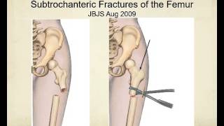 Proximal femur fractures how to identify and avoid malreduction malrotation [upl. by Collen]