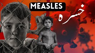 Measles Symptoms  Causes  Diagnosis  Treatment  khasra ka ilaj in urduhindi [upl. by Bazluke569]