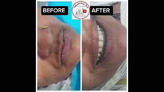 DENTAL IMPLANT SUPPORTED COMPLETE OVERDENTURE RESTORED FASCIAL AND DENTAL AESTHETIC amp FUNCTION [upl. by Anyahc]