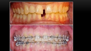 Dental Spaces and Braces Orthodontist [upl. by Jonette]